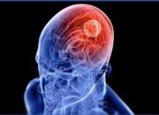 Pemkab Bojonegoro Ajak Warga Waspadai Tumor Otak Sejak Dini