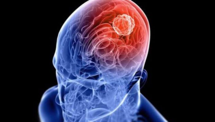 Pemkab Bojonegoro Ajak Warga Waspadai Tumor Otak Sejak Dini