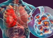 Ini Gejala Paru-Paru Basah yang Harus Kamu Tahu